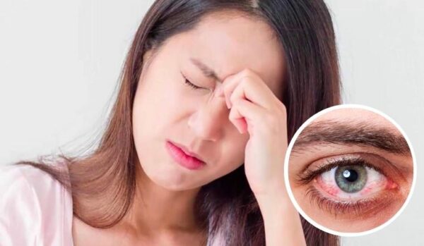 Dịch đau mắt đỏ lan rộng và những cách ngăn nhiễm bệnh