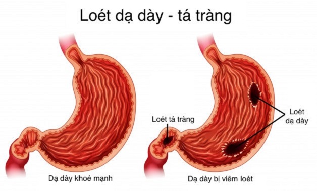 Dịch mật trào ngược – Nguyên nhân và cách điều trị