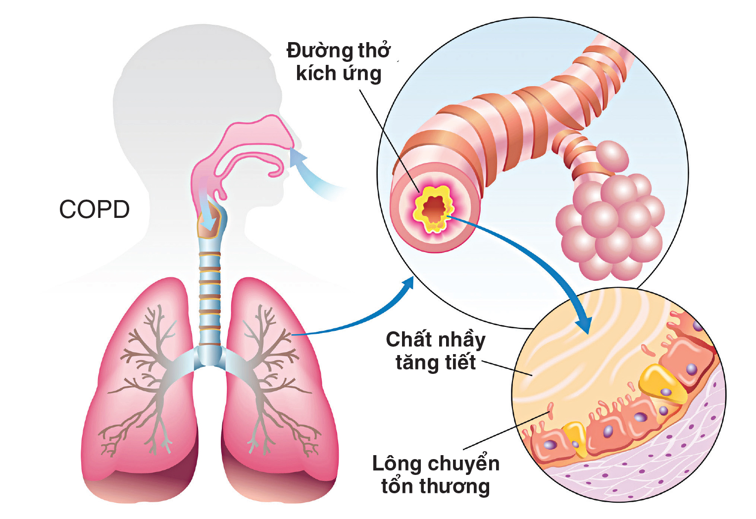 Dịch nhầy đường hô hấp nguyên nhân do đâu?