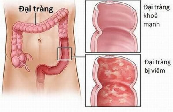 Điểm danh 3 dấu hiệu bệnh đại tràng thường gặp nhất