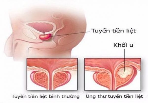 Điểm danh 5 loại ung thư dễ chữa nhất