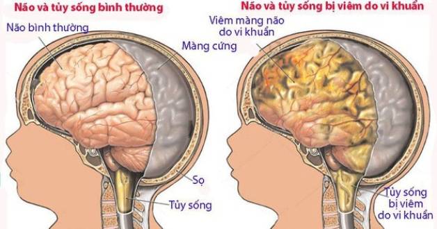 Điểm danh 7 loại vắc xin phòng viêm màng não mủ