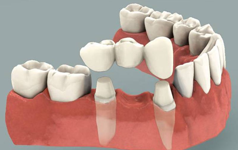 Điểm danh ba phương pháp trồng răng giả ưu việt hiện nay