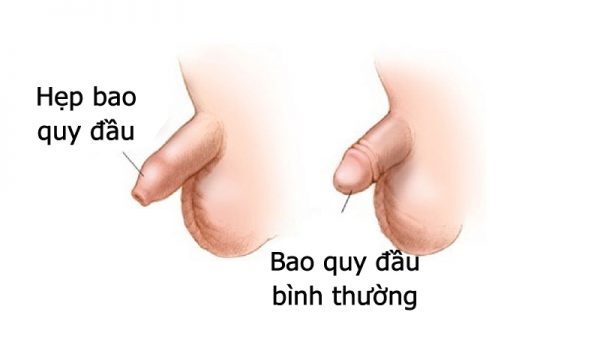 Điểm danh các bệnh bé trai dễ mắc phải mẹ cần lưu ý!