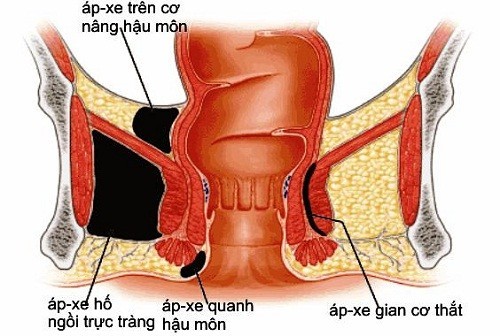 Điểm danh các bệnh lý viêm nhiễm vùng hậu môn