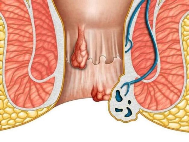 “Điểm danh” các cách chữa bệnh trĩ hiệu quả