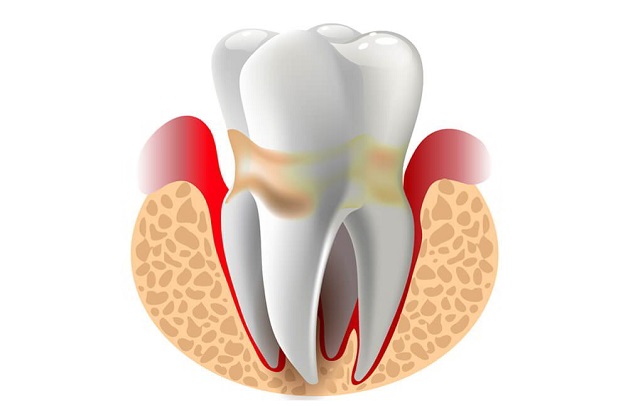 Điểm danh các triệu chứng viêm nha chu thường gặp nhất