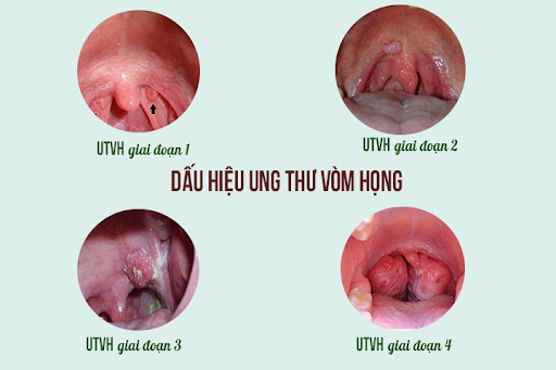 Điểm danh những biểu hiện ung thư vòm họng cần biết