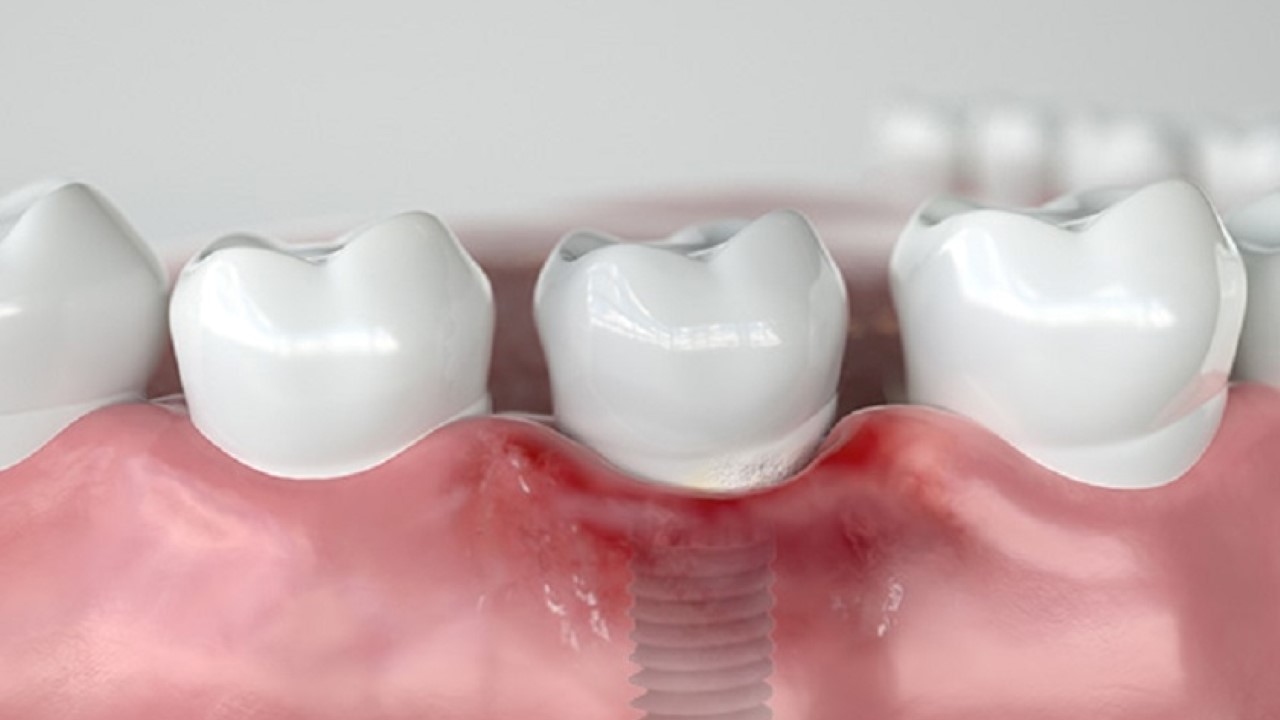 Điểm danh những nguy cơ khi trồng răng Implant giá rẻ