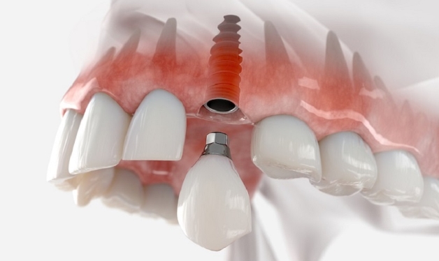 Điểm danh những nguy cơ khi trồng răng Implant giá rẻ