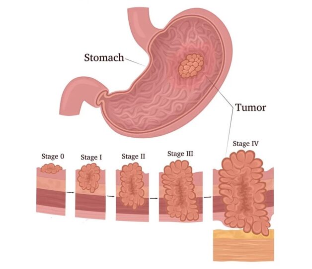 Điểm danh triệu chứng ung thư dạ dày giai đoạn đầu