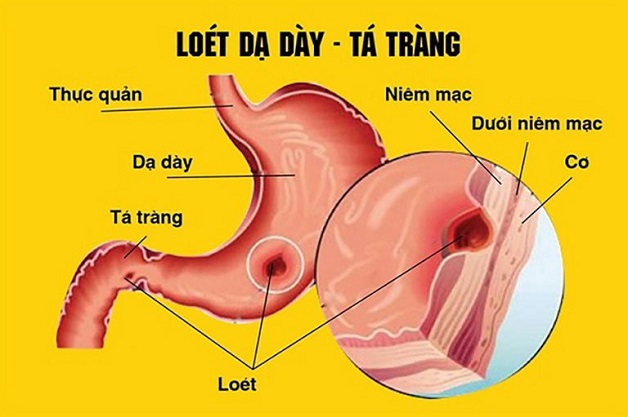 Điểm mặt 5 bệnh tiêu hóa phổ biến và dấu hiệu nhận biết