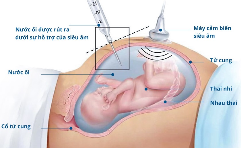 Điểm mặt 5 xét nghiệm sàng lọc trước sinh quan trọng!