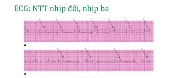 “Điểm mặt” 6 loại rối loạn nhịp tim thường gặp