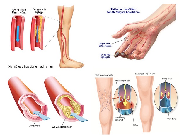 “Điểm mặt” các bệnh mạch máu ngoại vi thường gặp