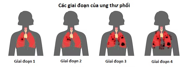 Diễn biến và điều trị ung thư phổi giai đoạn 3