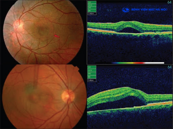 Điều cần biết về bệnh lý hắc võng mạc trung tâm thanh dịch