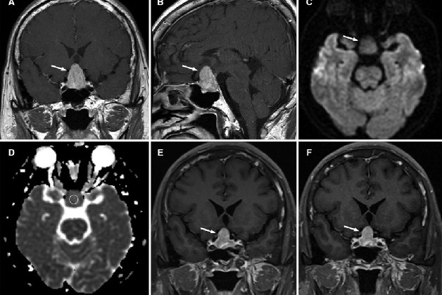 Điều cần biết về phương pháp chụp MRI tuyến yên