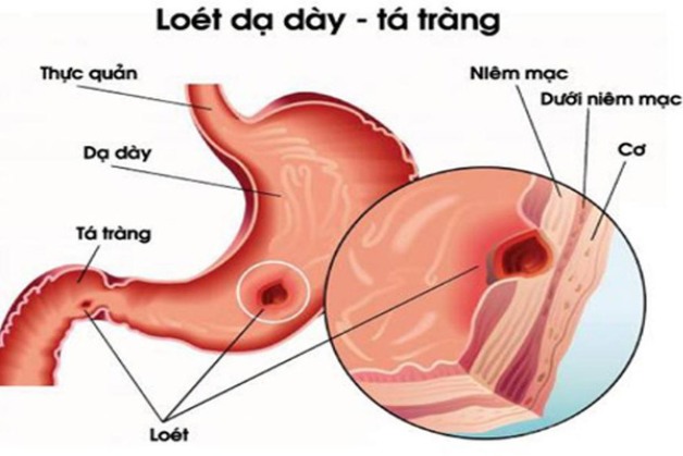 Điều cần biết về phương pháp nội soi dạ dày không đau