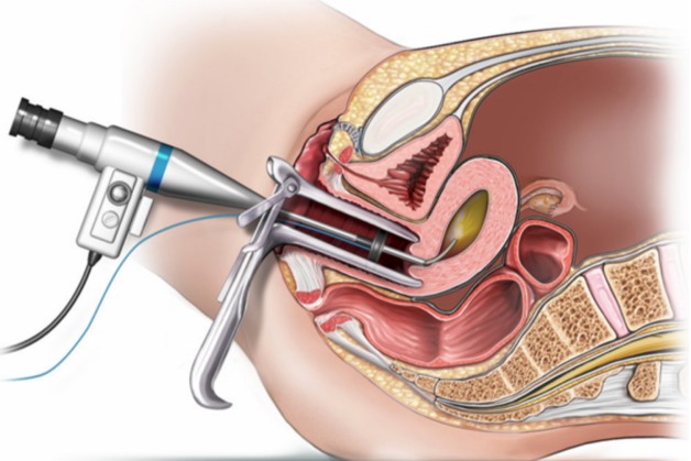 Điều cần biết về phương pháp nội soi tử cung