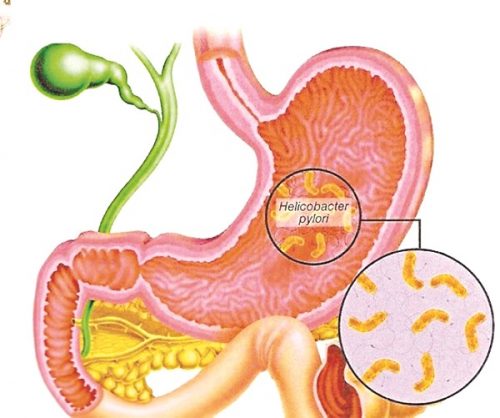 Điều trị bệnh loét dạ dày