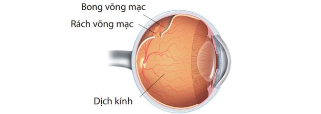 Điều trị bệnh lý bong võng mạc