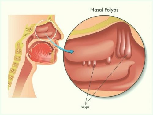 Điều trị bệnh polyp mũi ở đâu tại Hà Nội?