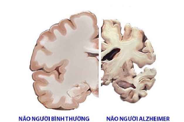 Điều trị bệnh suy giảm trí nhớ