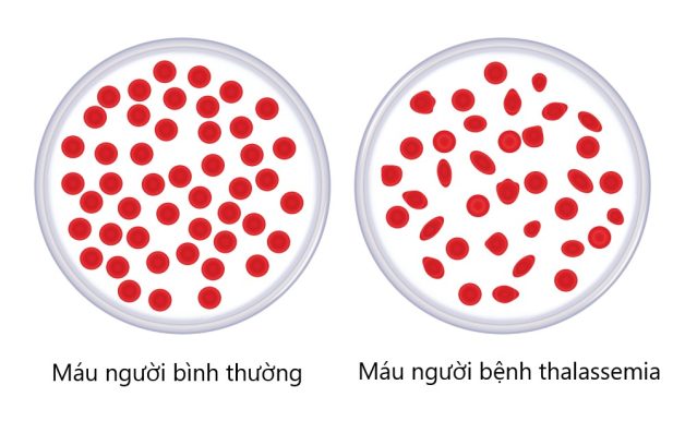 Điều trị bệnh thiếu máu huyết tán ở trẻ em