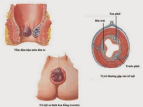 Điều trị bệnh trĩ thường gặp ở vùng hậu môn