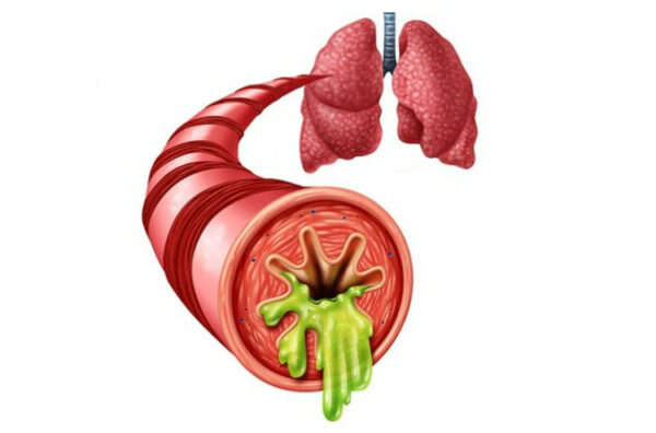 Điều trị bệnh viêm phế quản mãn tính và cấp tính ở trẻ em