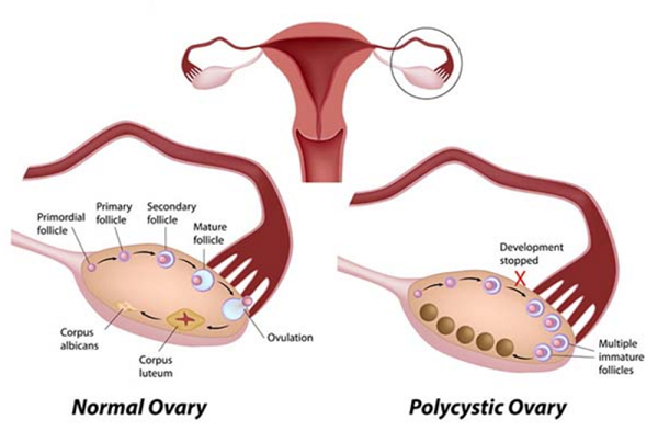 Điều trị buồng trứng đa nang thế nào?