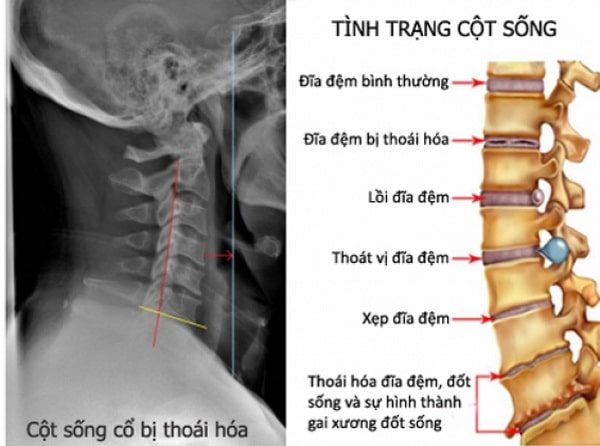 Điều trị đau dây thần kinh vai gáy