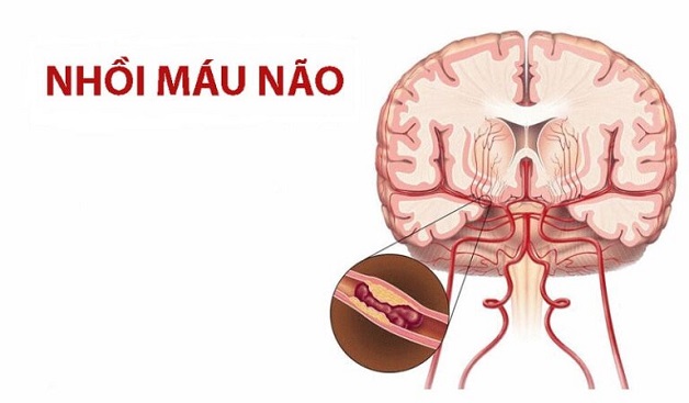 Điều trị đột quỵ nhồi máu não bằng thuốc