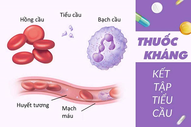 Điều trị đột quỵ nhồi máu não tính bằng giây, phút