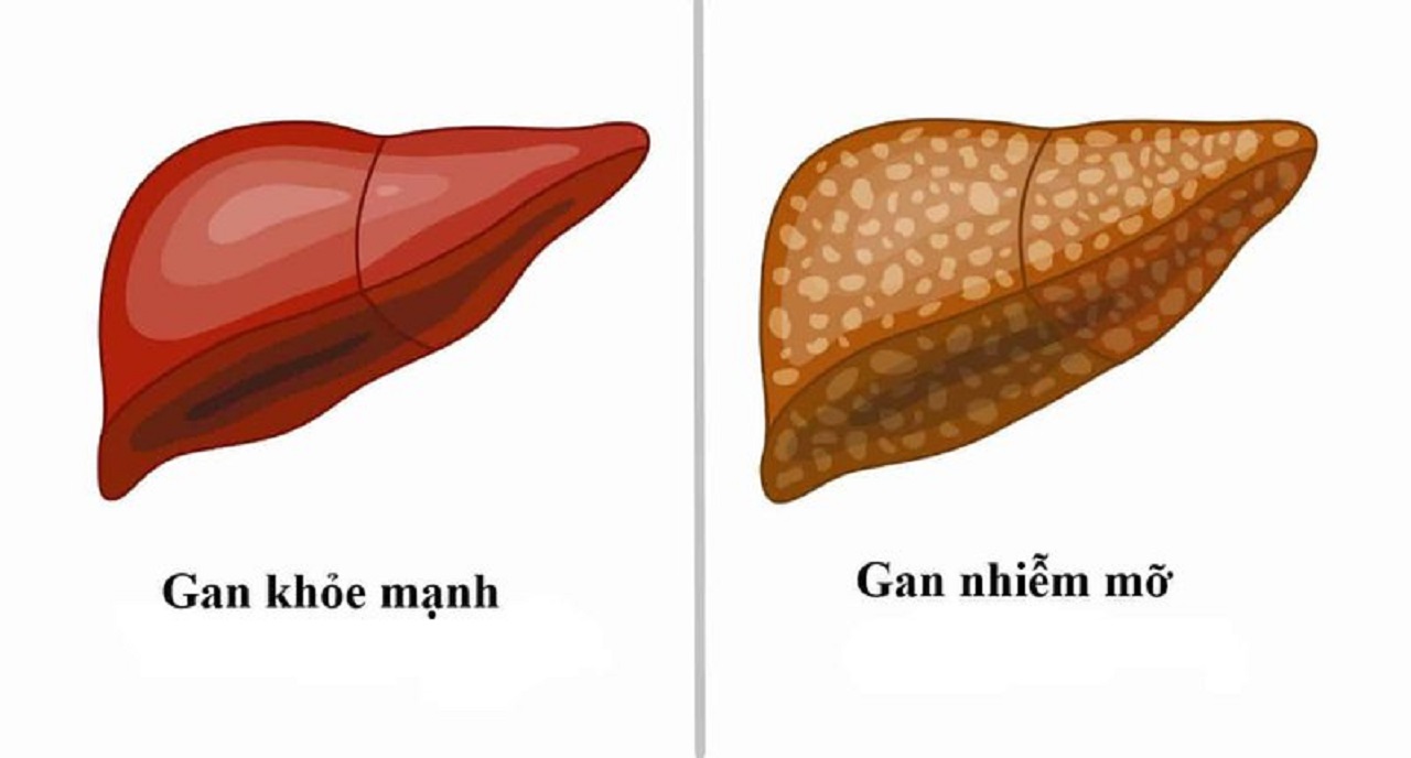 Điều trị gan nhiễm mỡ từ chế độ ăn và lối sống khoa học