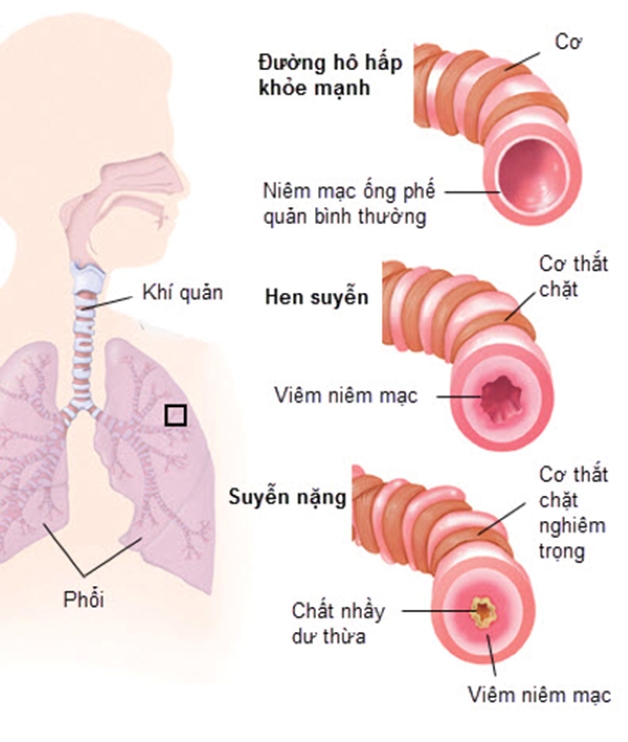 Điều trị hen ở trẻ em và những điều chưa biết