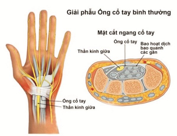 Điều trị hội chứng ống cổ tay: không thể chậm trễ