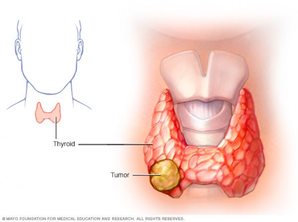 Điều trị hoóc môn cho người ung thư tuyến giáp