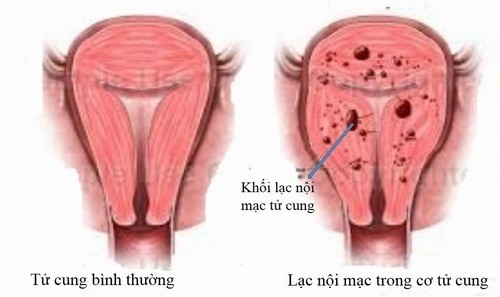 Điều trị lạc nội mạc tử cung HIỆU QUẢ triệt để nhất