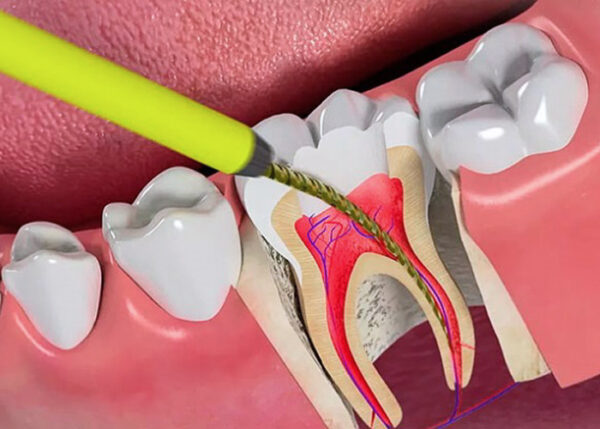 Điều trị lấy tủy răng: Quy trình và thời gian thực hiện