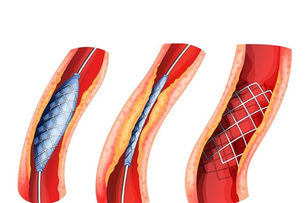 Điều trị nội soi tán sỏi niệu quản hiệu quả