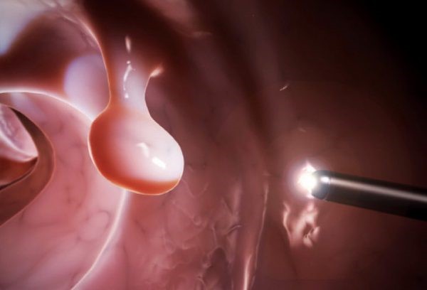 Điều trị polyp dạ dày thế nào?