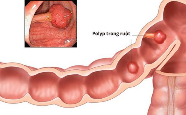 Điều trị Polyp đại trực tràng ở trẻ em bằng cách nào?