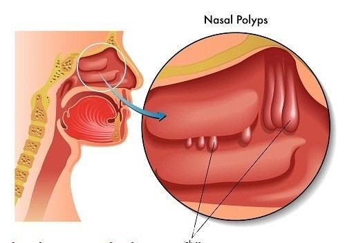 Điều trị polyp mũi