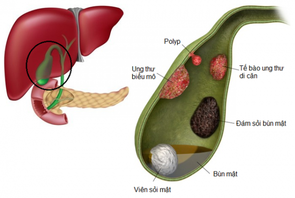 Điều trị Polyp túi mật không phải khi nào cũng cần cắt bỏ