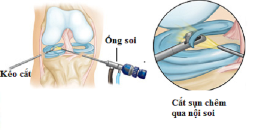 Điều trị rách sụn chêm kịp thời hiệu quả tránh biến chứng