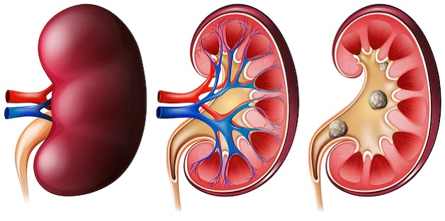 Điều trị sỏi kẹt niệu đạo như thế nào?