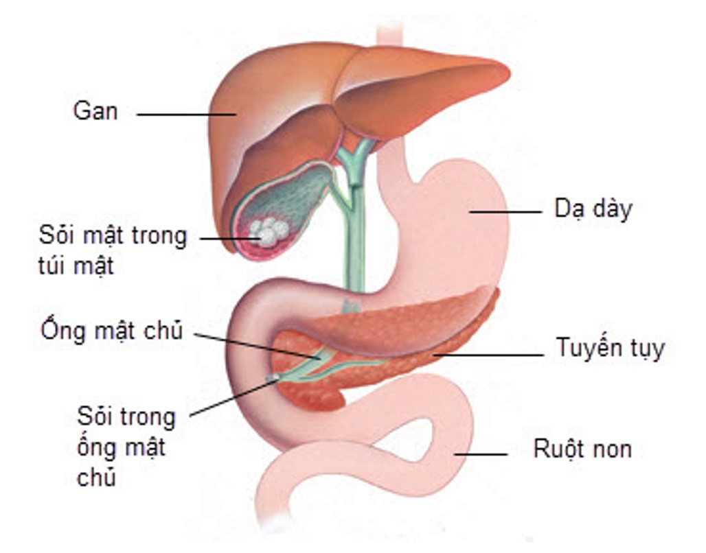 Điều trị sỏi mật hiệu quả bằng cách nào? – Góc giải đáp