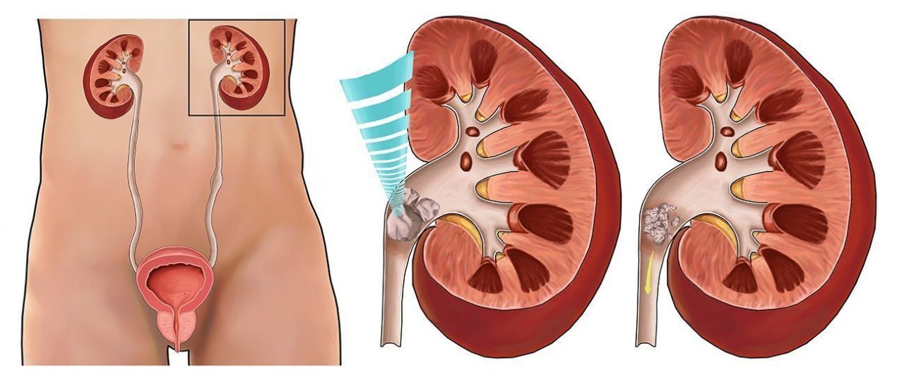 Điều trị sỏi tiết niệu không mổ – Tán sỏi ngoài cơ thể là gì?